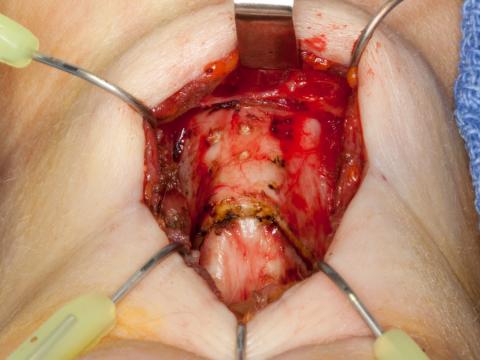 Removing the upper thyroid alae