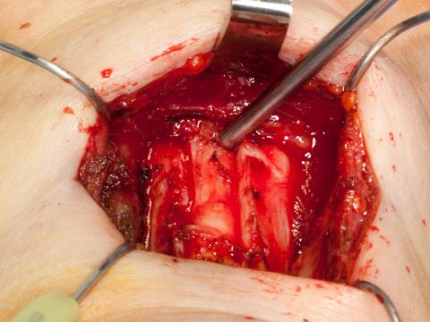 Removing the central thyroid cartilage with two vertical saw incision