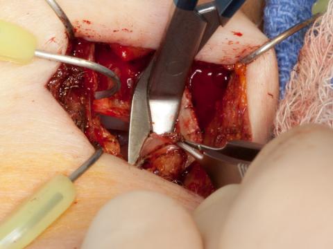 Removing the anterior false vocal cord