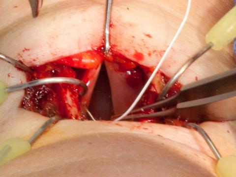 Marking the midpoint of the vocal cords with a Gore-Tex suture