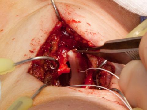 Tensioning the right vocal cord