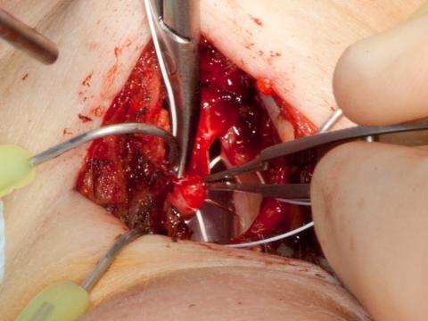 Using Gore-Tex suture to reconstruct the anterior commissure