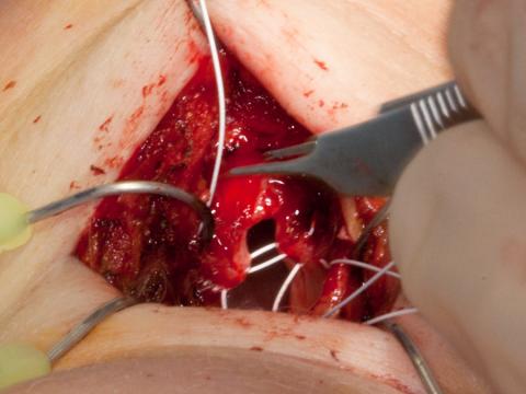 Using Gore-Tex suture to create a new anterior commissure