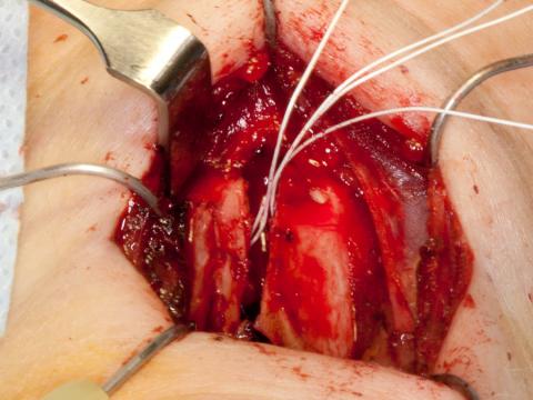 Placing the thyroid cartilage back into position