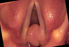 post intubation granuloma