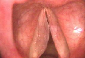 a polyp that extends the length of the vocal cord in a smoker