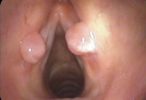 False vocal cord granulomas from a chronic cough