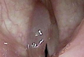 During phonation, the smokers polyp tends to ride on the superior surface of the vocal cord.