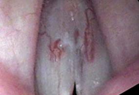 Capillaries are visible on the edge of the vocal cord during stroboscopy