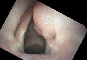 abduction view of the larynx with swelling of the right side