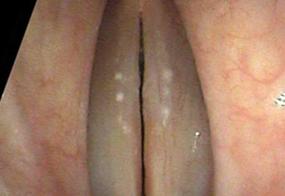 Very small, Central vocal cord thickening, a nodule or a polyp