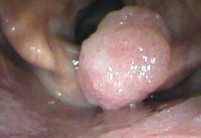 Papilloma of the right arytenoid