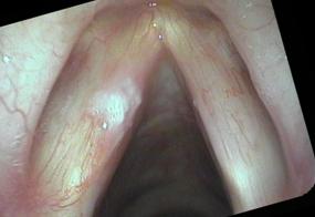 leukoplakia on left vocal cord