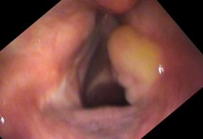 Vocal cord granuloma