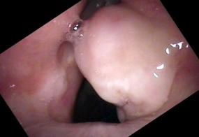 Vocal cord granuloma