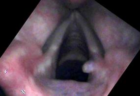 Vocal cord granuloma