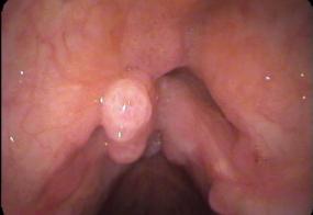 Laryngeal papilloma in multiple locations