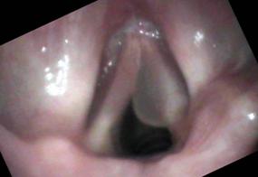 Smokers polyps or Reinke's edema during breathing in