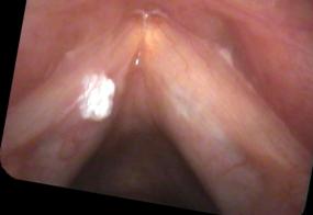 Leukoplakia - verrucous keratosis