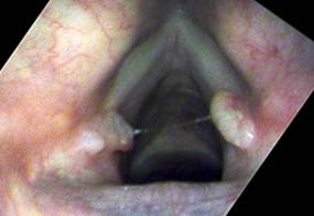 Vocal cord granulomas