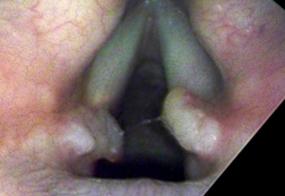 Vocal cord granulomas