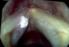 Leukoplakia - verrucous keratosis