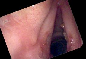 chronic bacterial laryngitis