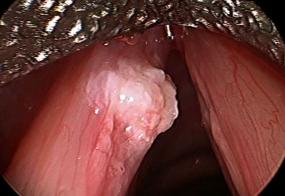 verrucous keratosis lesion viewed during surgery with a 30° endoscope