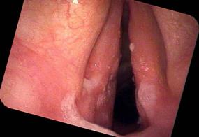 chronic bacterial laryngitis