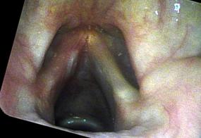 verrucous keratosis lesion one month after excision