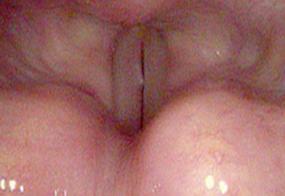 verrucous keratosis lesion two months after excision during stroboscopy