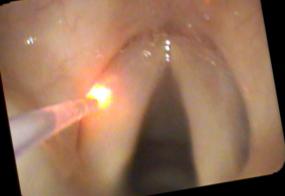 KTP laser tuning of the vocal cords to raise and smooth the speaking pitch