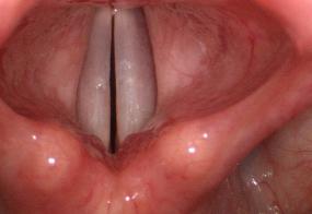 Normal vocal cords during adduction