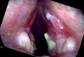 close-up of vocal cord ulcerations after and in a tracheal intubation for 5 days