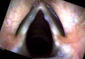 Vocal cord nodules during abduction