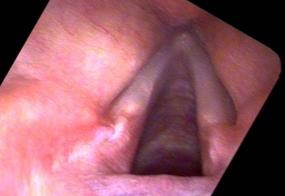 Vocal cord granulomas