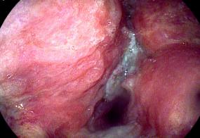 Squamous cell carcinoma of the vocal cords