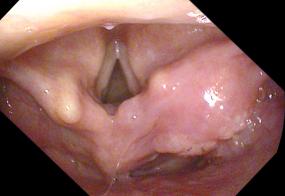 carcinoma of the outside wall of the right aryepiglottic fold