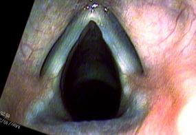 4 months after excision of vocal cord nodules