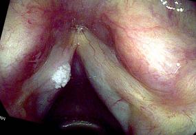 verrucous keratosis lesion 18 months after excision