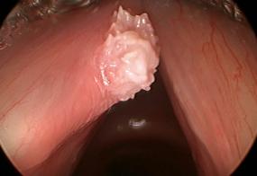 verrucous keratosis viewed during surgery with a 30° endoscope