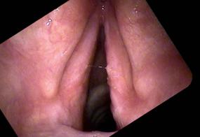 recurrent bacterial laryngitis treated with sulfa