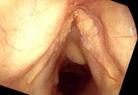 Fungal laryngitis from Flovent