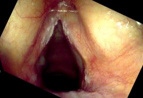 Fungal laryngitis on Pulmicort inhaler