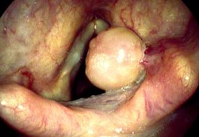 Right arytenoid granuloma