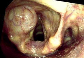 internal laryngocoele