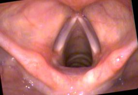 Normal young female vocal cords