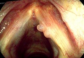 Hemorrhagic vocal cord polyp, bilobed, on the right vocal court
