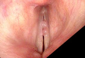 Hemorrhagic vocal cord polyp during stroboscopy
