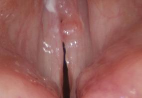 Hemorrhagic vocal cord polyp examination with rigid endoscope